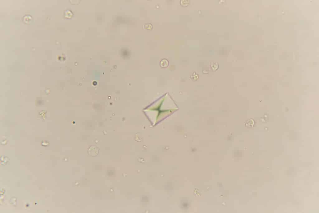 Calcium oxalate crystal in urine